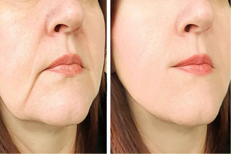 Feeling Fine With Fat Transfer Recovery Tips in Fresno, CA