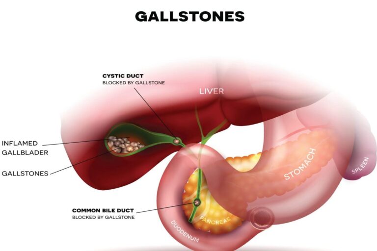 which size of gallbladder stone is dangerous