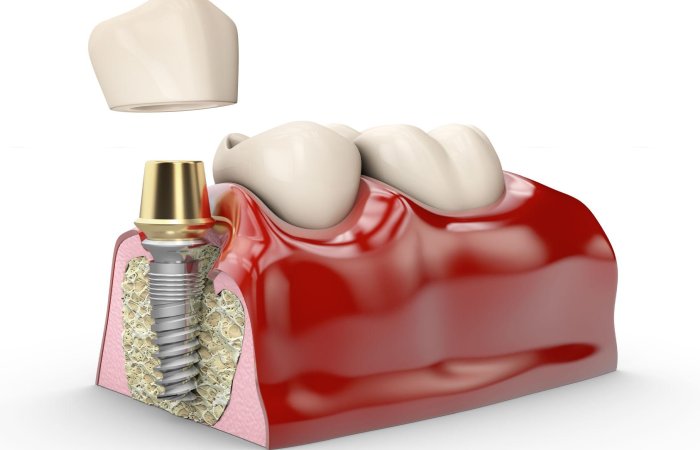 dental implant procedure hyderabad