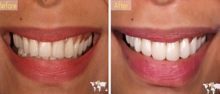 smile makeover before after galaxy dental hyderabad